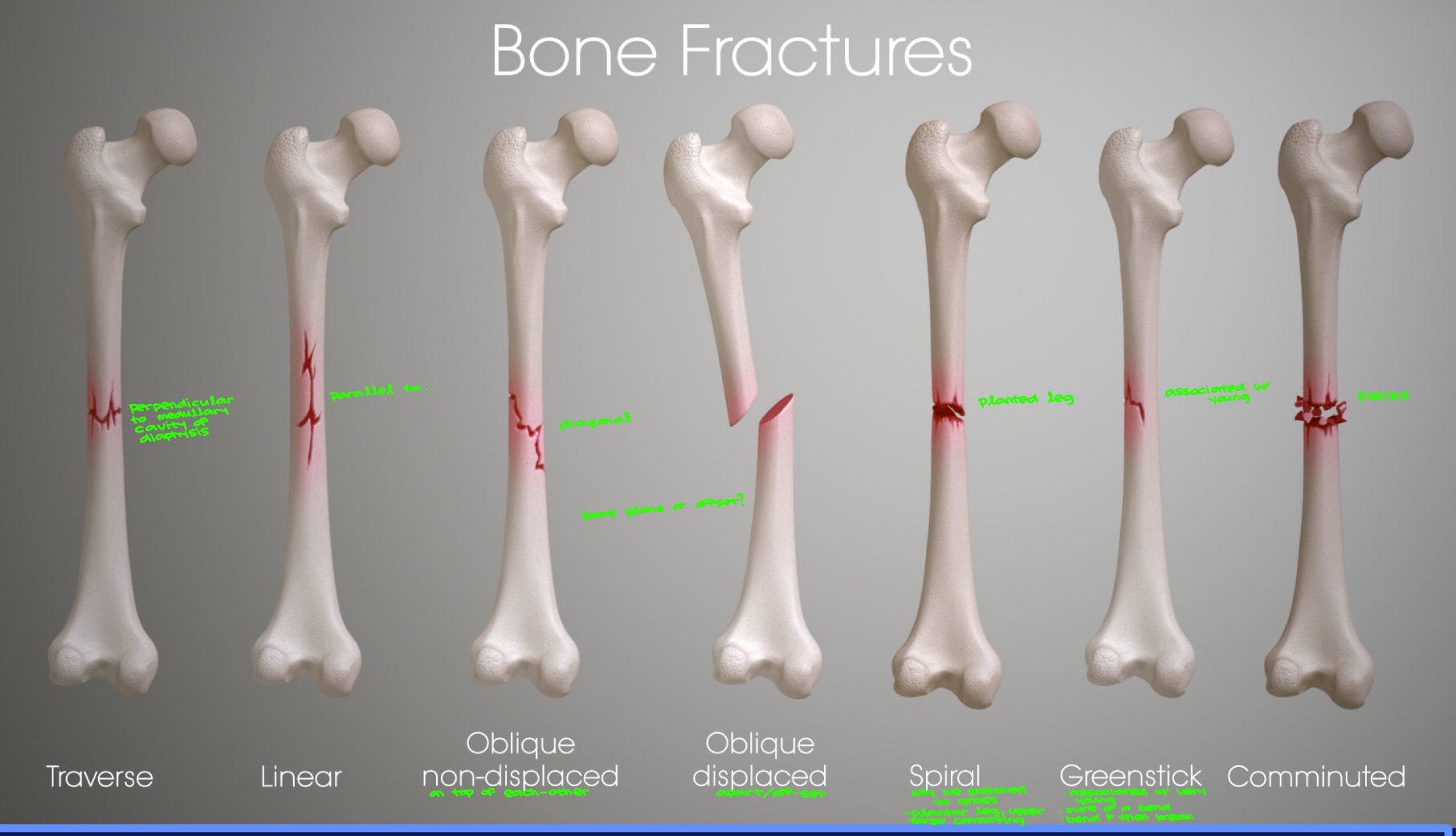 <p><strong><em><u>Oblique</u></em></strong> fractures are when the break is at an angle. A <strong><em><u>compound</u></em></strong> fracture has broken the skin. <strong><em>**Transverse and Traverse are the same!!</em></strong></p><ul><li><p><strong><em>Traverse</em></strong>: perpendicular to medullary cavity of diaphysis&nbsp;</p></li><li><p><strong><em>Linear</em></strong>: parallel to…</p></li><li><p><strong><em>Oblique non-displaced</em></strong>: diagonal, on top of each other&nbsp;</p></li><li><p><strong><em>Oblique displaced</em></strong>: apart/off-set&nbsp;</p><ul><li><p>same plane or offset?</p></li></ul></li><li><p><strong><em>Spiral</em></strong>: planted leg… why we switched to grass. plantar leg, upper torso contorting&nbsp;</p></li><li><p><strong><em>Greenstick</em></strong>: associated w/ young… bend then break&nbsp;</p></li><li><p><strong><em>Comminuted</em></strong>: pieces </p></li></ul><p></p>