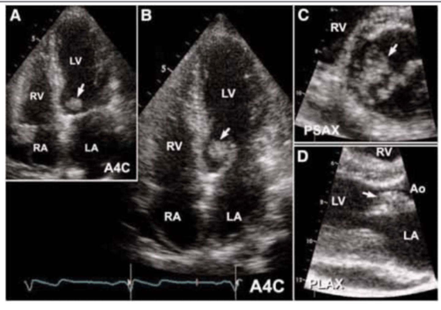 <p>Echocardiogram (usually transesophageal)</p>