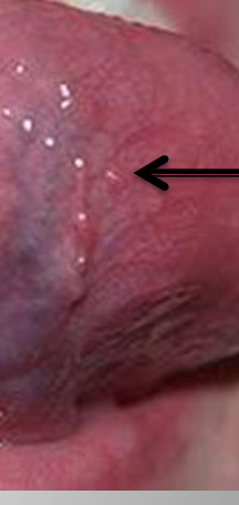 <p><span>a fold resembling a fringe on the under surface of the tongue on either side of the frenulum</span></p>