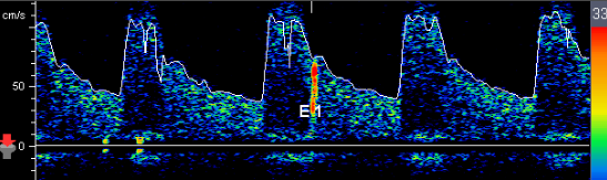 <p>Patient presents with cryptogenic stroke. TCD Bubble Study ordered and you obtain this image with 3rd saline injection. Consider following questions.</p><p>1. What does the red item marked 'E1' indicate? </p><p>2. Is patient having a stroke with this 'E1'? </p><p>3. What is cryptogenic stroke? </p><p>4. Provide an example of source of stroke. </p>