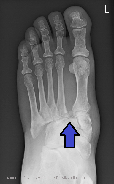 <p>What sign on X-ray indicates possible Lisfranc injury?</p>