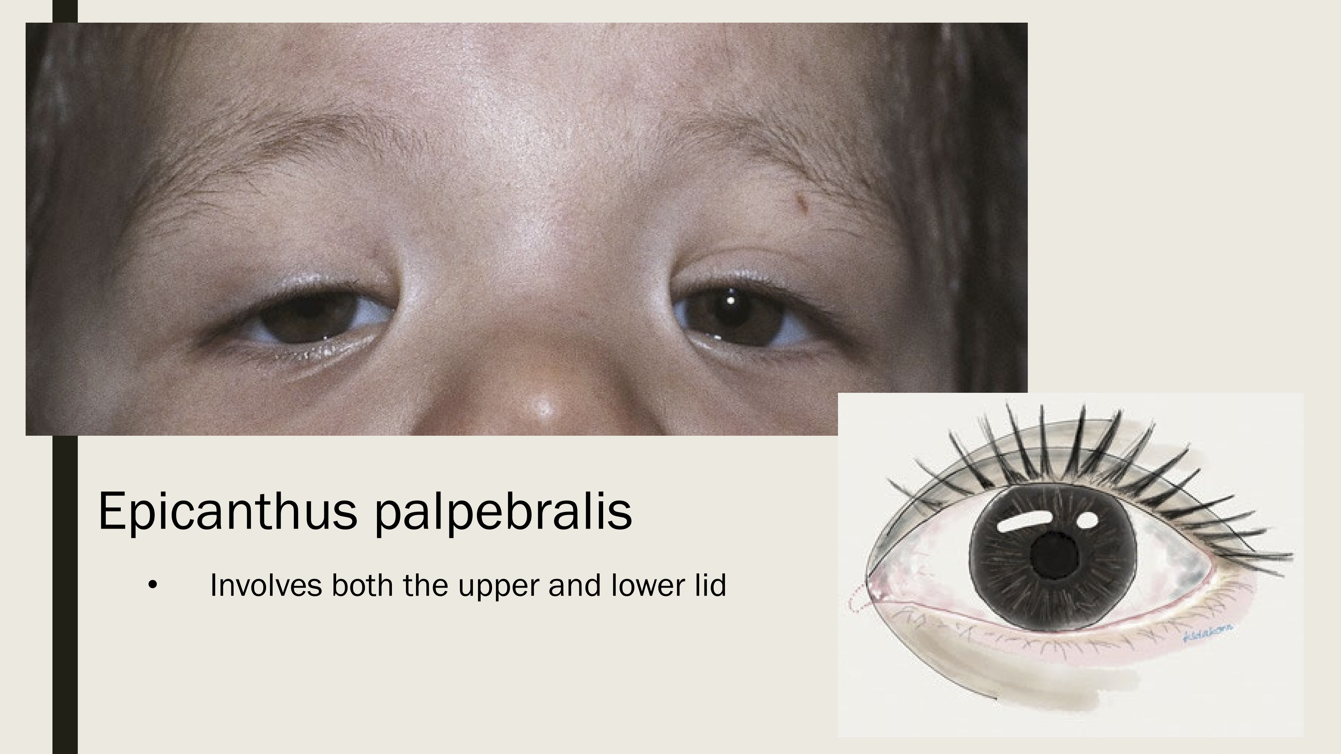 <p>Excess skin on both upper and lower lids</p>