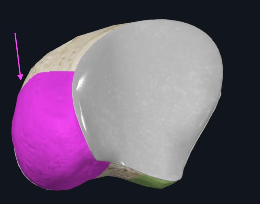 <p>Se encuentra en la cara inferior del navicular, es una rugosidad en la porción medial y es sitio de inerción del  músculo tibial posterior</p>