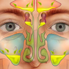 <p>rhinosinusitis</p>