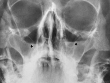 <p>increased density and/or fluid levels in an upright sinus radiograph</p>