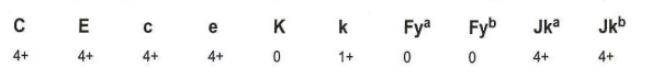<p>264-A 5-year-old with chronic upper respiratory infections arrives in the Emergency Room with chronic anemia. The antibody screen and antibody identification panel are all strongly reactive when tested by solid phase automation. The direct antiglobulin test (DAT) is negative, and the patient's phenotype is shown in the panel. With these initial findings, what is suspected?</p><p></p>
