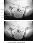 <p>What is this x-ray demonstrating?</p>