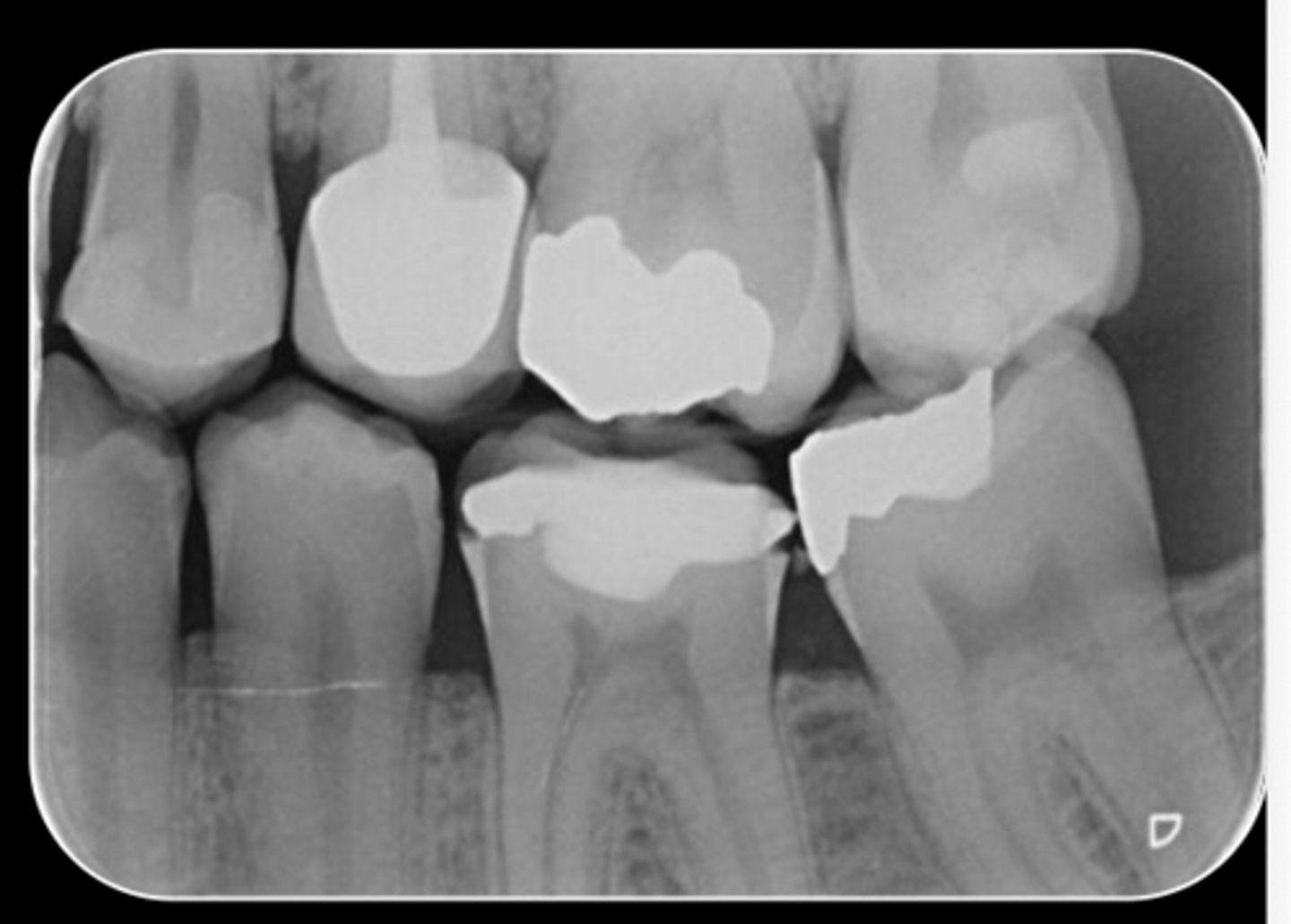 <p>What are the radiographic findings on #13?</p>