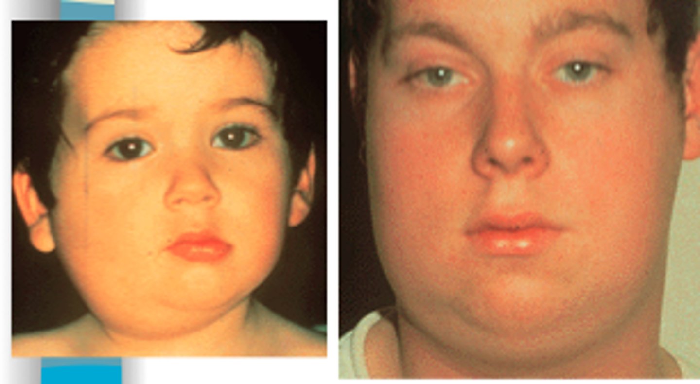 <p>inflammation of the parotid gland</p>