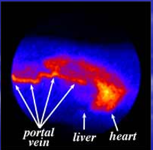 <p><em>image</em>&nbsp;- Composite image showing the uptake of radioactive dye into the portal vein.Notice that the dye bypasses the liver and appears in the heart and lungs first&nbsp;</p>