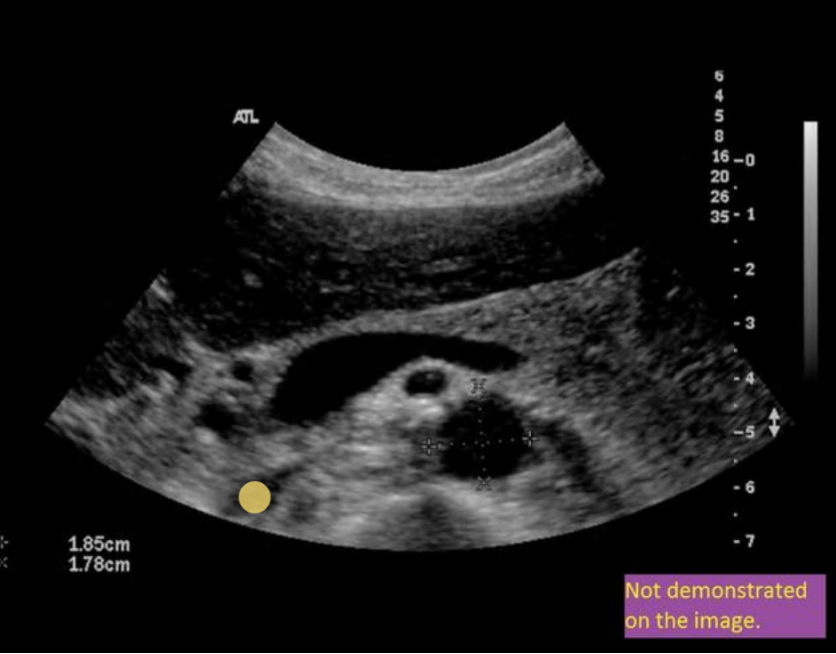 <p>IVC = posterior to panc head</p>