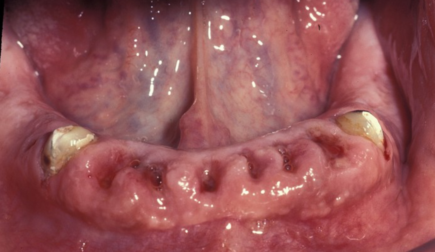 <p>Immediate denture + leave some overdenture abutments for support. They don’t help with retention but provide stability and support</p>