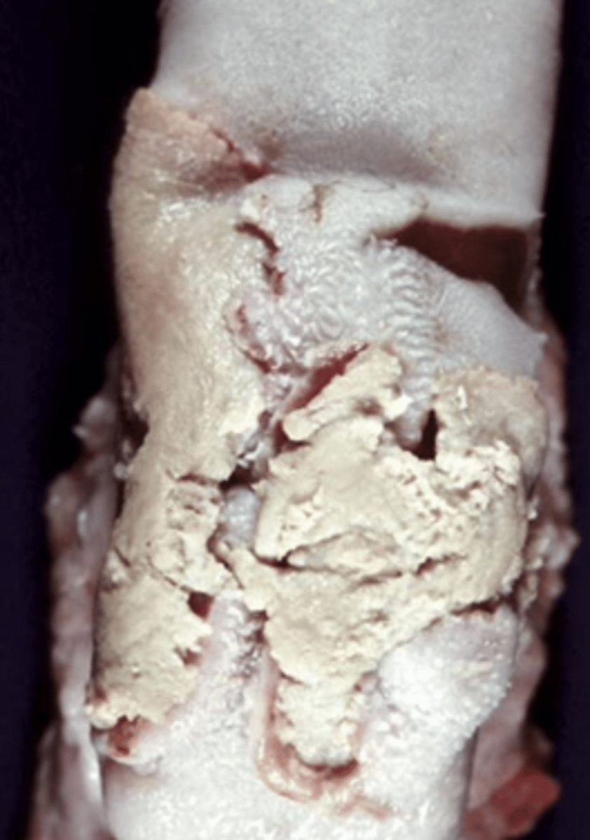 <p>- Typically occurs secondary to abrasion and/or trauma to the mucosal epithelium of the oral cavity or larynx (classic location is larynx). The causative agent, Fusobacterium necrophorum, is common in the URT of cattle when the mucosa is compromised. This leads to bilateral necrotizing laryngitis.</p>