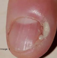 <p>superficial infection of proximal and/or lateral nail folds, S/Sx: red, swollen, tender</p>