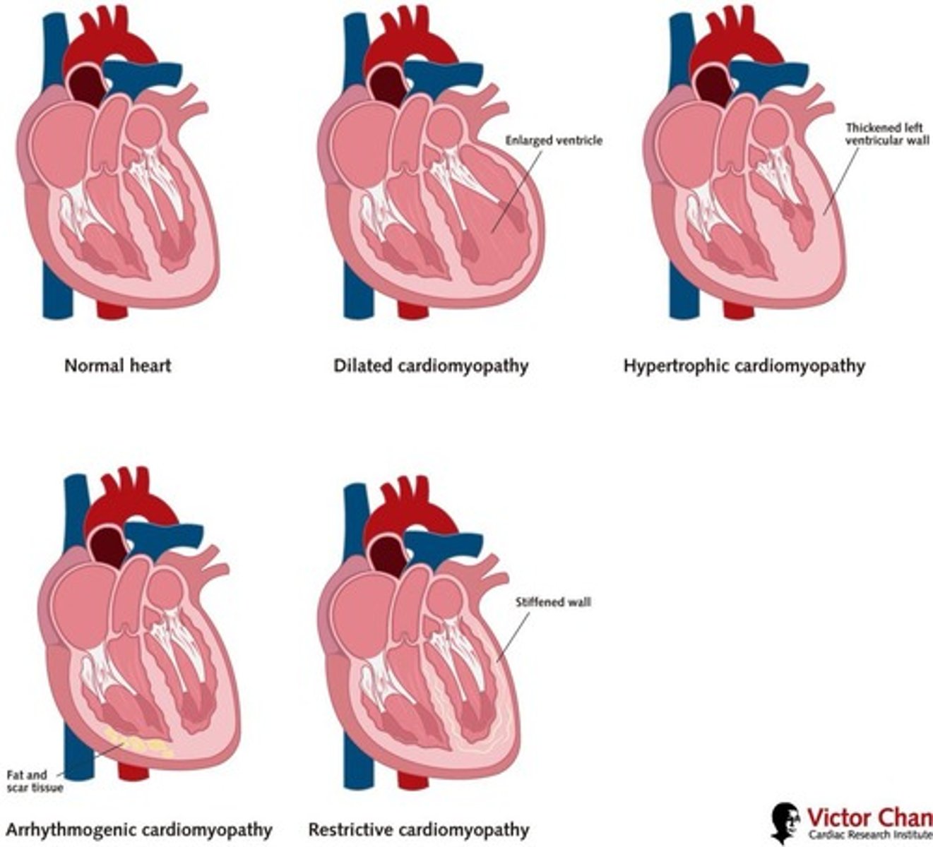 <p>Both genetic and non-genetic origins; heart dilation.</p>