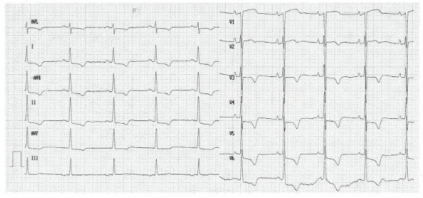 <p>HFpEF: Normal</p><p>ST-segment and T-wave changes</p><ul><li><p>Elevation</p></li><li><p>Depression</p></li></ul><p>P wave changes</p><ul><li><p>Biphasic</p></li></ul><p>Long QTc interval</p>