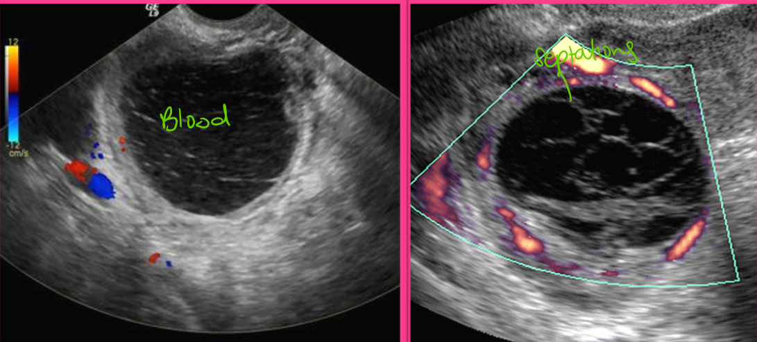 <p>An acute hemorrhagic cyst is usually _______ and may mimic a ____ _____. It appears with a ______ posterior wall and ______</p>
