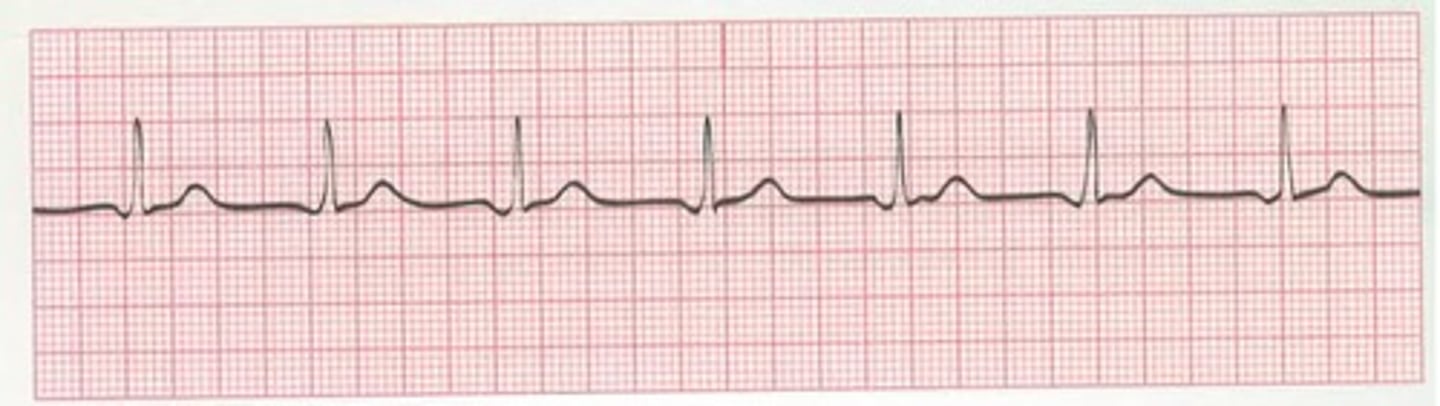 <p>Which Arrythmia is this?</p>