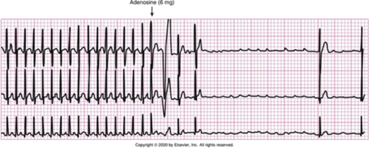 <p>Rapid IV push (1-2 secs), followed by rapid normal saline flush, half life= 10 secs</p><p>Have crash cart in room with ECG monitoring</p><p>Nursing considerations: Monitor ECG continuously </p>