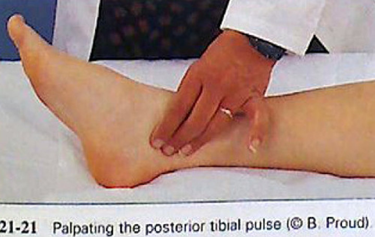 <p>instructions:</p><p>This assessment is used to assess the pulse symmetry and amplitude of each leg vessel. This test will take a few minutes to do. At this time I would ask patient to remove their shoes and socks so I can inspect the lower extremities. Palpating the arteries of the foot while the patient may lay back comfortably.</p><p>procedure:</p><p>To find the posterior tibial pulse you may find the medial malleolus (ankle bone) and palpating posterior to this bone to find the pulse. Palpating the dorsalis pedis pulse we would place our fingers on the dorsum of the foot about midline up near the ankle.</p>