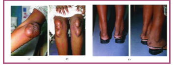 Various lipid disorders are sometimes associated with Subcutaneous Xanthomas particularly along the tendon sheets or over the extensors surfaces of the extremities