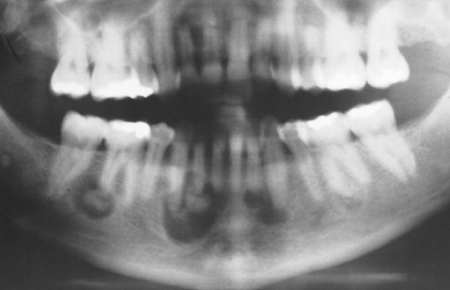 <p>Florid Osseous Dysplasia</p>
