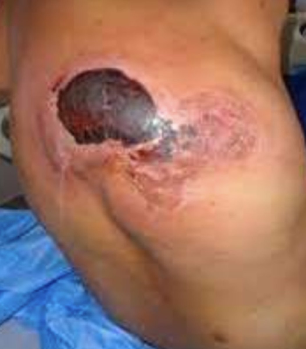 <p>¿lesión?</p><p>¿primaria o secundaria?</p>