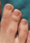 <p>Condition in which the skin and tissues between the toes or fingers are joined.</p>