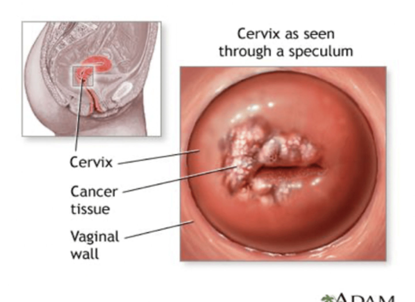 <p>columnar epithelium; exposed to acid in the vagina and transforms to squamous epithelium. transforming cells are more likely to become cancerous</p>