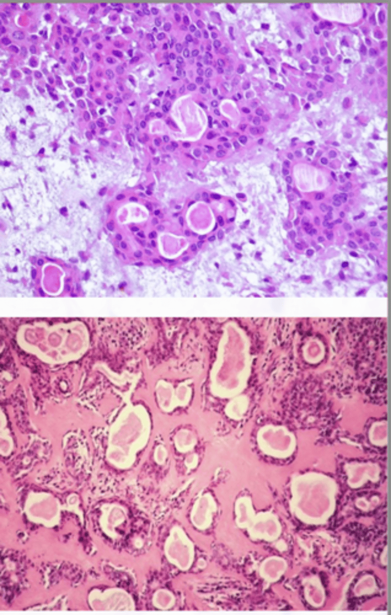 <p>Various patterns within the tumor, Encapsulated</p><p>Double layered ductal structures and myoepithelial cells, Stroma appears myxoid, cartilaginous, and hylanized</p>