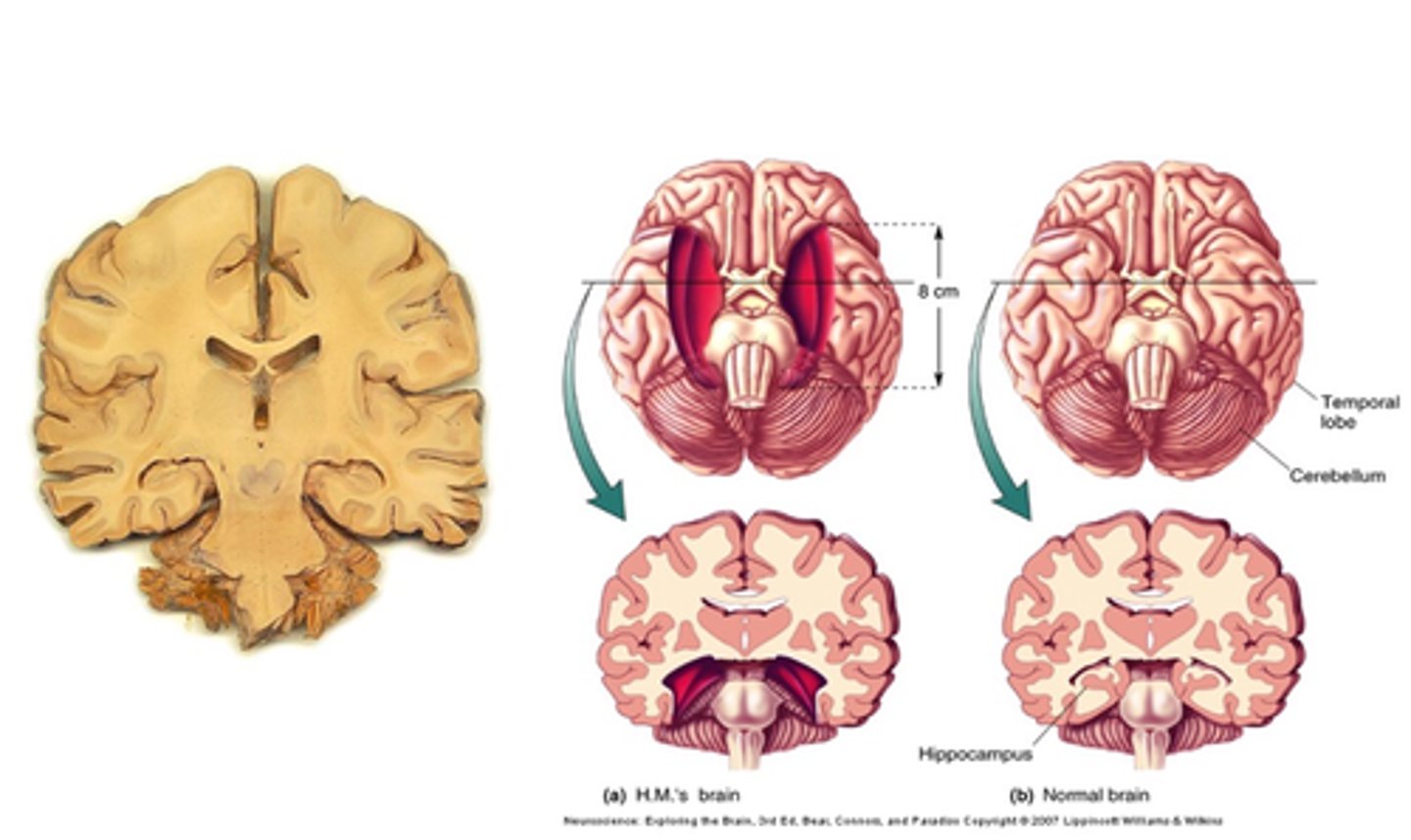 <p>What do hippocampal lesions (elective or accidental) cause?</p>