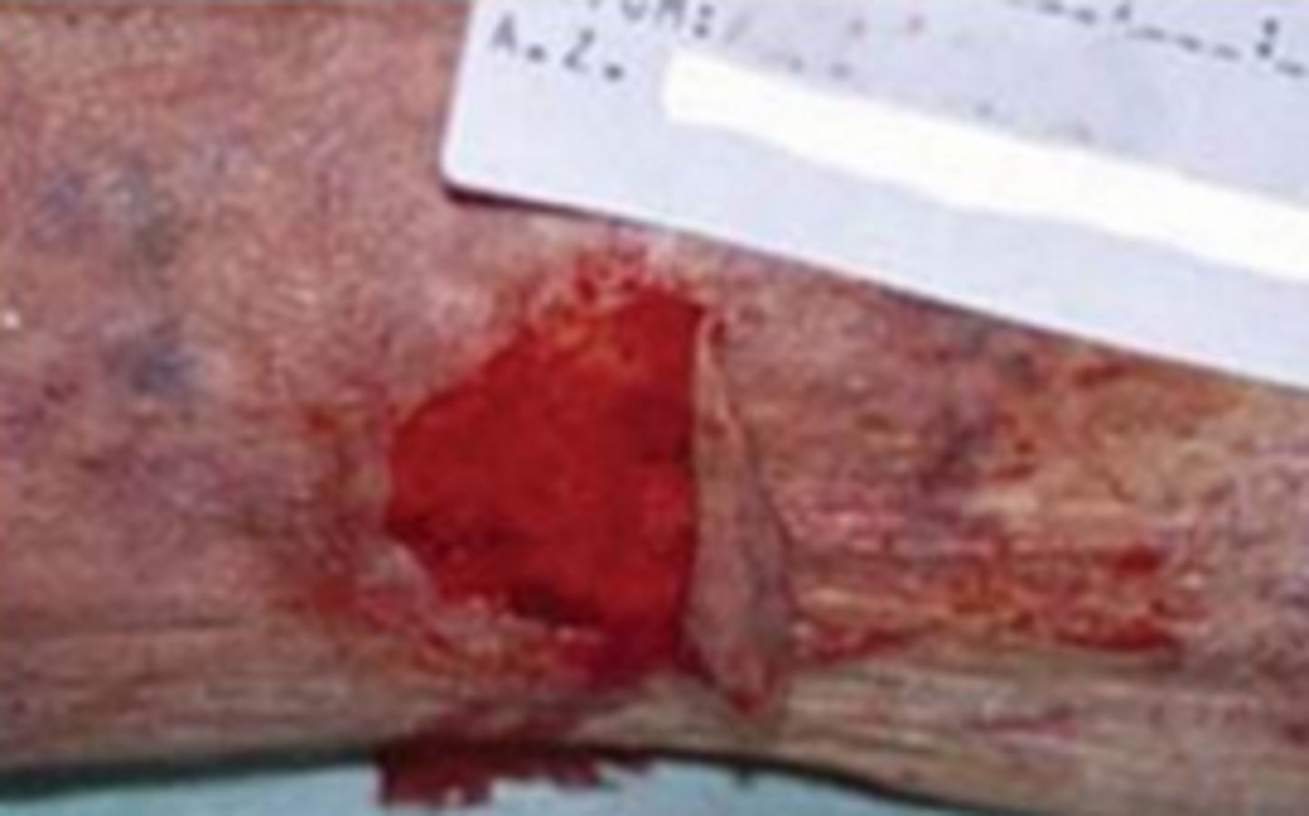 <p>a break or rip in the outer layers of the skin</p><p>the epidermis separates from the underlying tissues</p>