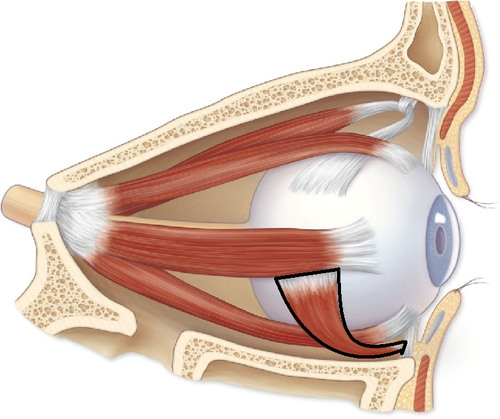 <p>inferior oblique muscle</p>