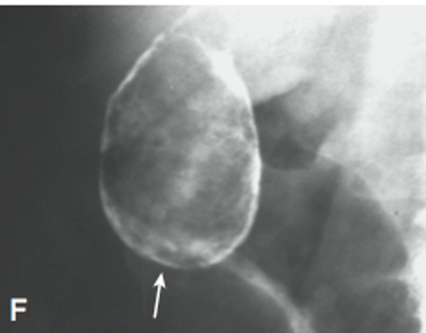 <p>calcification of the wall of a hollow organ</p>