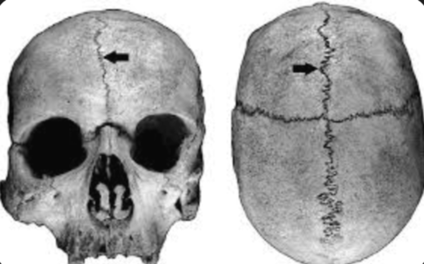 <p>unfused in young children, only present in a few adults</p>