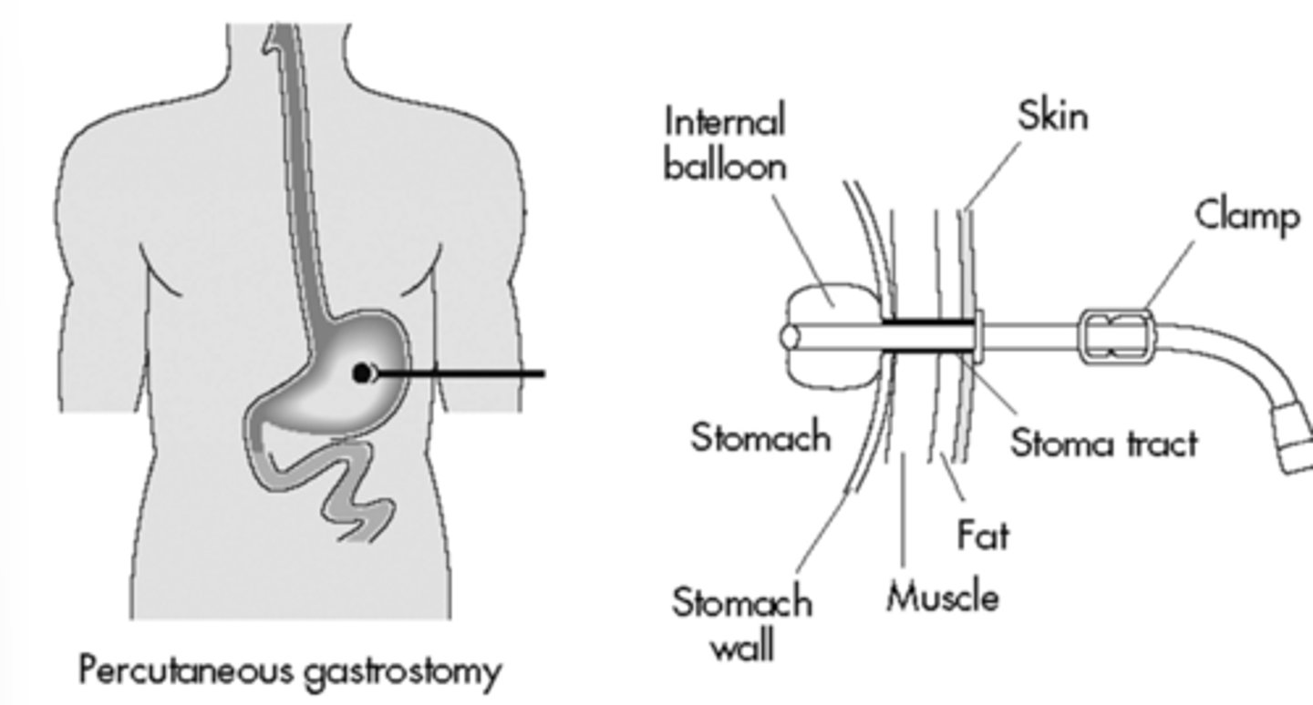 <p>Therapy Considerations for NG, PEG, &amp; PEJ Tubes:</p><p>- While running nutritional support, PT to _________________________ or determine if can be temporarily held.</p><p>- Avoid _______________________, Trendelenburg position.</p><p>- Typically HOB restriction &gt;______________________.</p><p>- Ensure feeding tube is properly secured before/during/after session. → Safety pin to gown to avoid discomfort.</p>