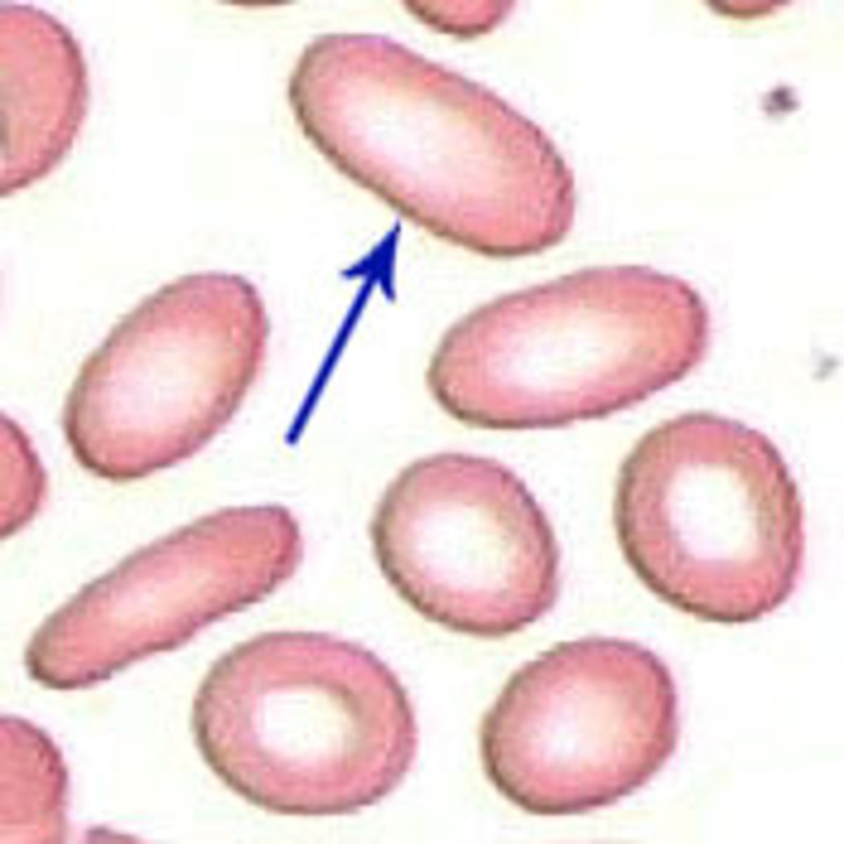 <p>elliptocyte = cigar shape<br>ovalocyte= egg<br><br>hereditary ellipocytosis or ovalocytosis</p>