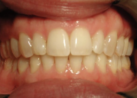 <ul><li><p><span style="background-color: transparent;">defined by a normal molar and canine relationship</span></p><ul><li><p><span style="background-color: transparent;">where mesiobuccal cusp of upper 1st molar is located over mesiobuccal groove of lower molar&nbsp;</span></p></li></ul></li></ul><img src="https://knowt-user-attachments.s3.amazonaws.com/5686a6a2-a53c-4d54-bfda-6e5d0422255f.png" data-width="75%" data-align="center"><p></p>