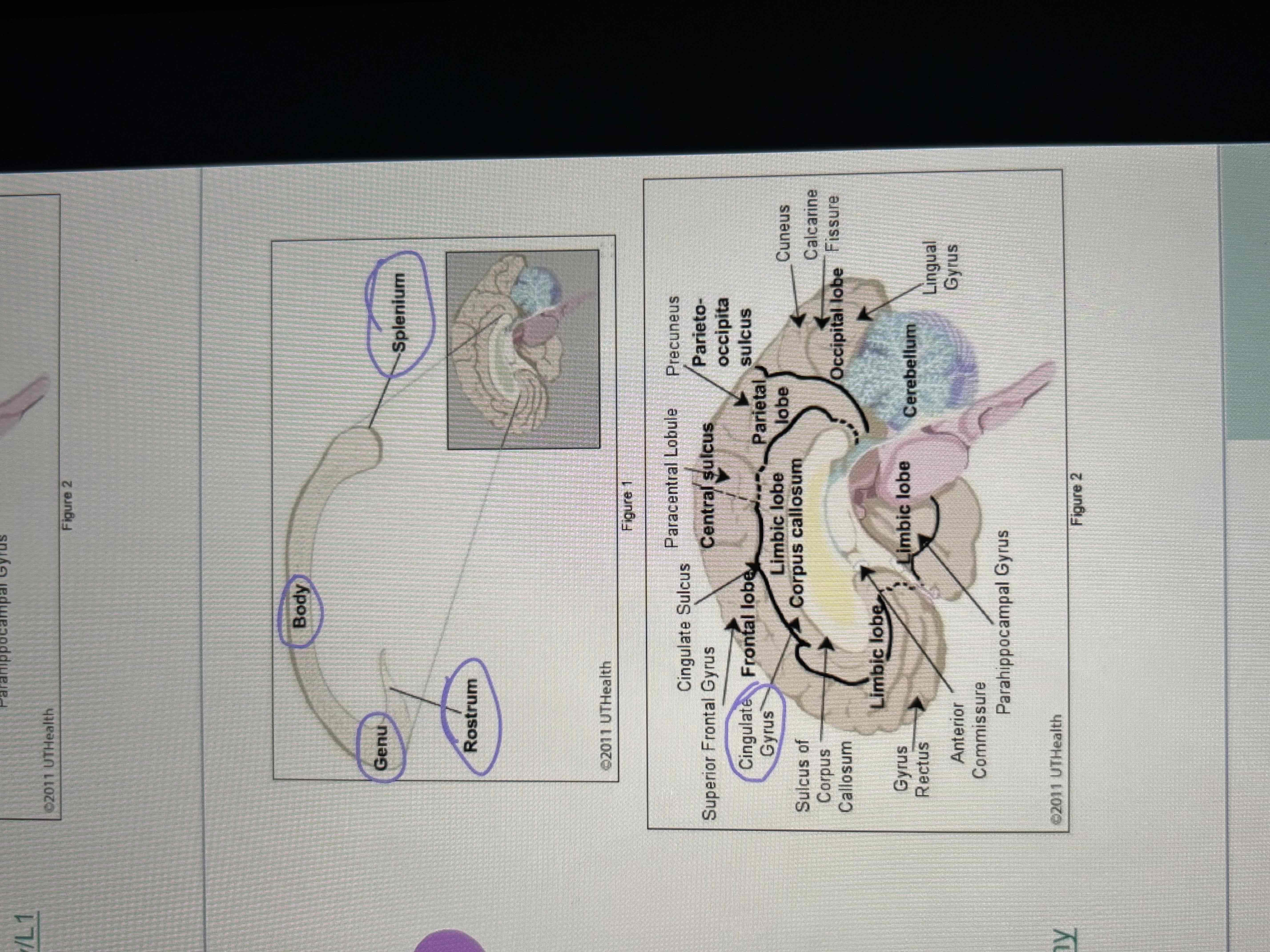 <ul><li><p>1. rostrum </p></li><li><p>2. Genu</p></li><li><p>3. Body</p></li><li><p>4. Splenium </p></li><li><p>Cingulate gyrus sits above </p></li><li><p>Septum pellucidum sits below </p></li></ul>