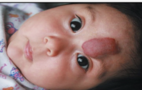 <p>Mass of superficial, dilated blood vessels present at birth; usually disappears without treatment.</p>