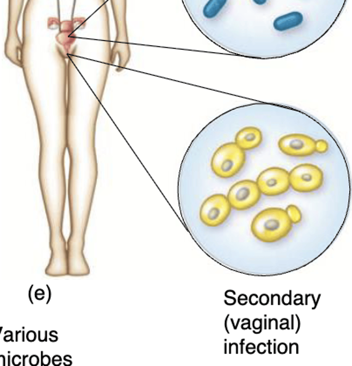 <p>another infection by a different microbe</p>