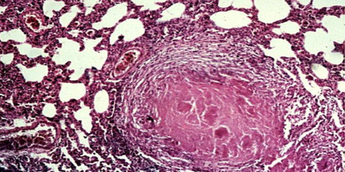 <p>It is a cheese-like necrosis, typically a feature of a granuloma of TB seen in latent infections </p><p>(ghon lesion with soft tissue)</p>