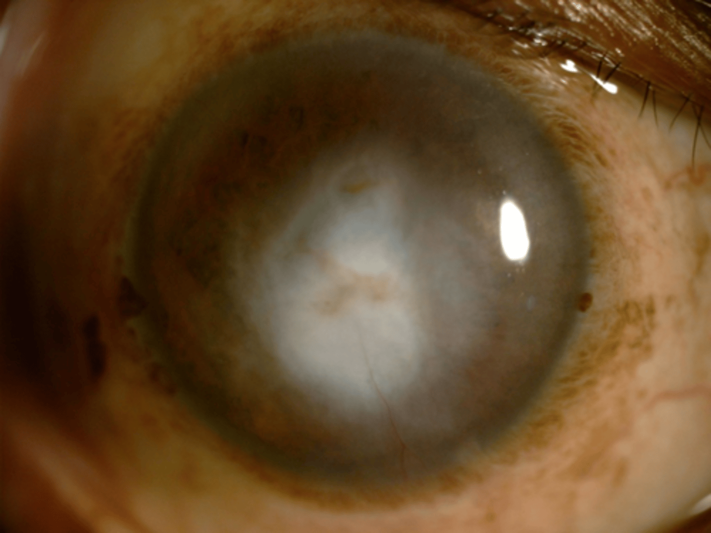 <p>What indication for corneal transplant is seen here?</p>