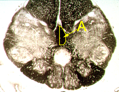 <p>If structure "A" is lesioned, describe the signs/symptoms that will be present.</p><p><span>A. Contralateral loss of pain and temp to the body</span></p><p><span>B. Ipsilateral loss of vibratory sense to the lower half of the body</span></p><p><span>C. Contralateral loss of fine touch to the body</span></p><p><span>D. Ipsilateral spastic paresis to the body</span></p><p><span>E. Ipsilateral flaccid paralysis to the lower extremity</span></p><p></p>