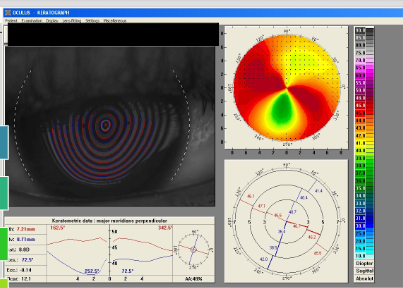 <p>Purpose and uses</p><p>Scales</p><p>Maps</p><p>Indices</p><p>Pachymetry</p><p>Meibomian gland evaluation</p>