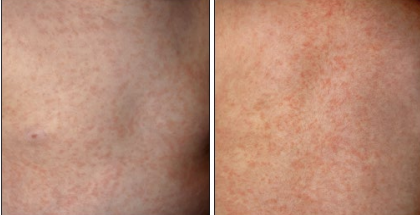 <p><strong>Roseola Infantum: Symptoms</strong></p><p>-High _____ for 3-5 days (often _ 103 F) </p><p>-Rash after fever resolves </p><ul><li><p>Blanching, ________ or maculopapular rash that is rose-pink</p></li><li><p>Starts on _____ and trunk and spreads to the ____ and extremities </p></li><li><p>Lasts __-__ days on average </p></li></ul><p>-Cervical, postauricular, and/or occipital ________________ (very common)</p><p>-Cold symptoms like _____ and rhinorrhea are possible, as are ________/diarrhea </p><p></p>