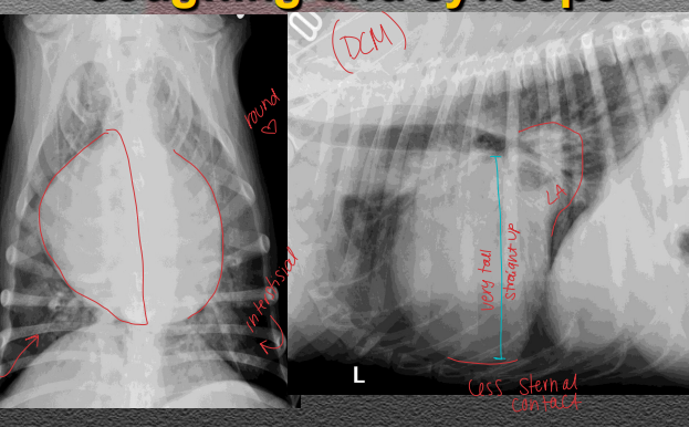 <p><span>Dilated Cardiomyopathy (DCM)</span></p>