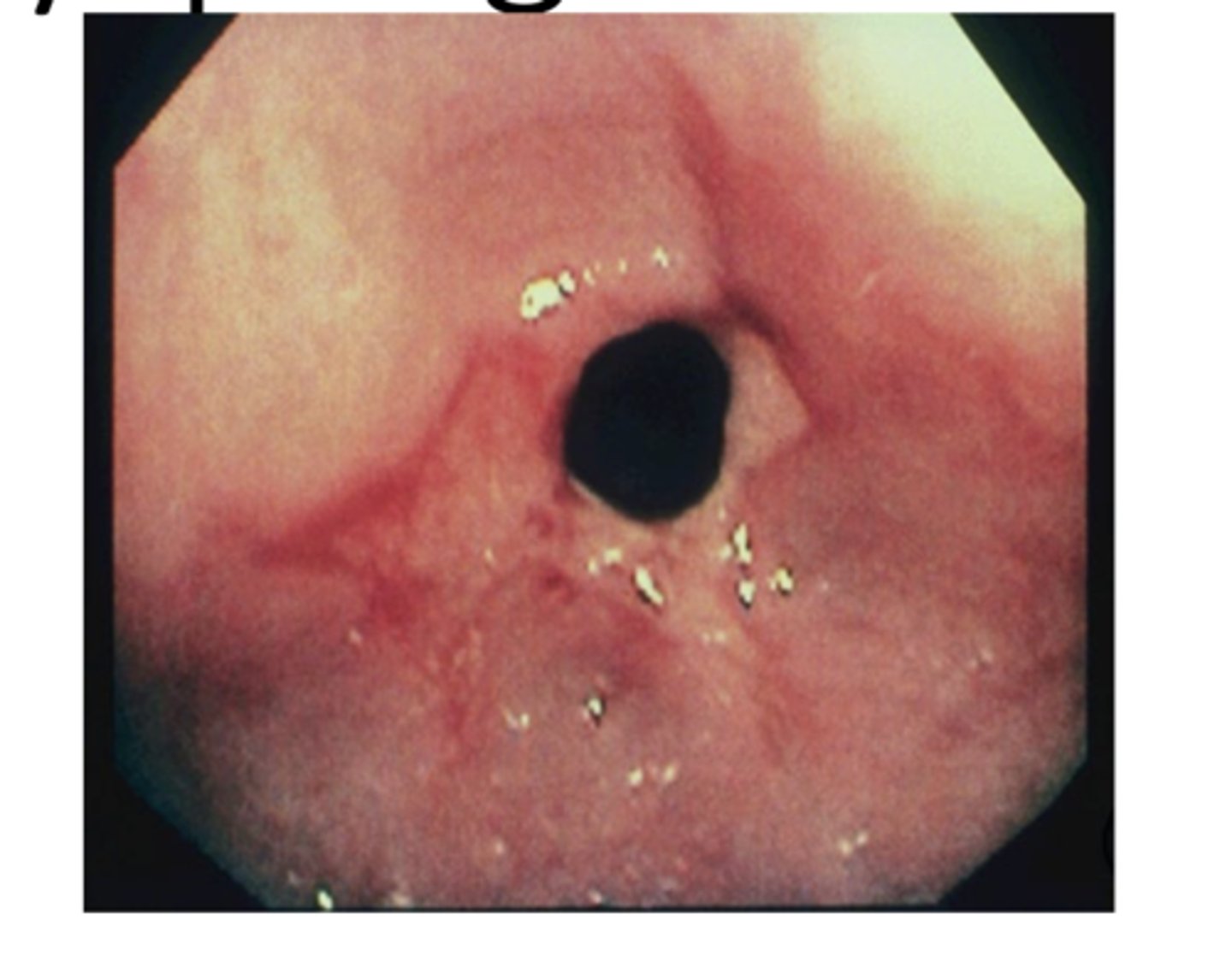 <p>-consequence of GERD or other insult</p><p>-dysphagia to solids</p>