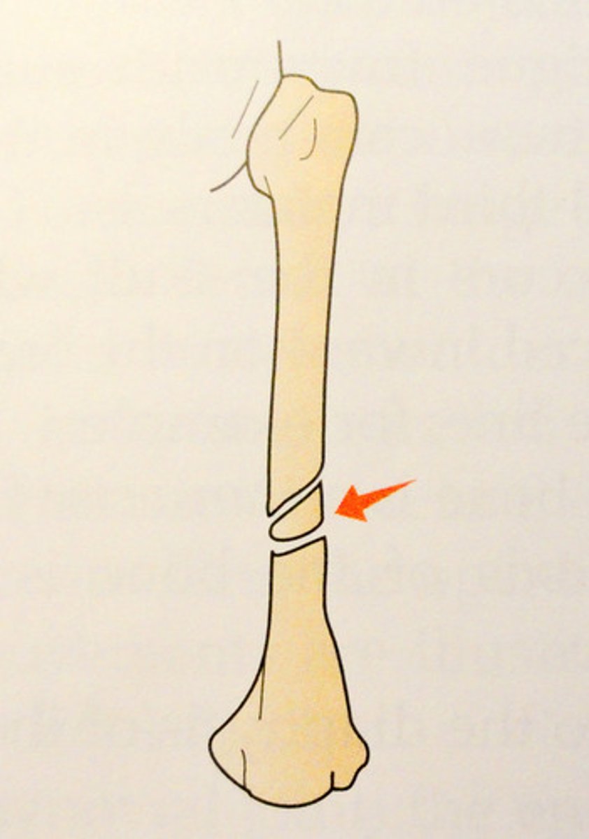 <p>large fragments separate from main bone</p>