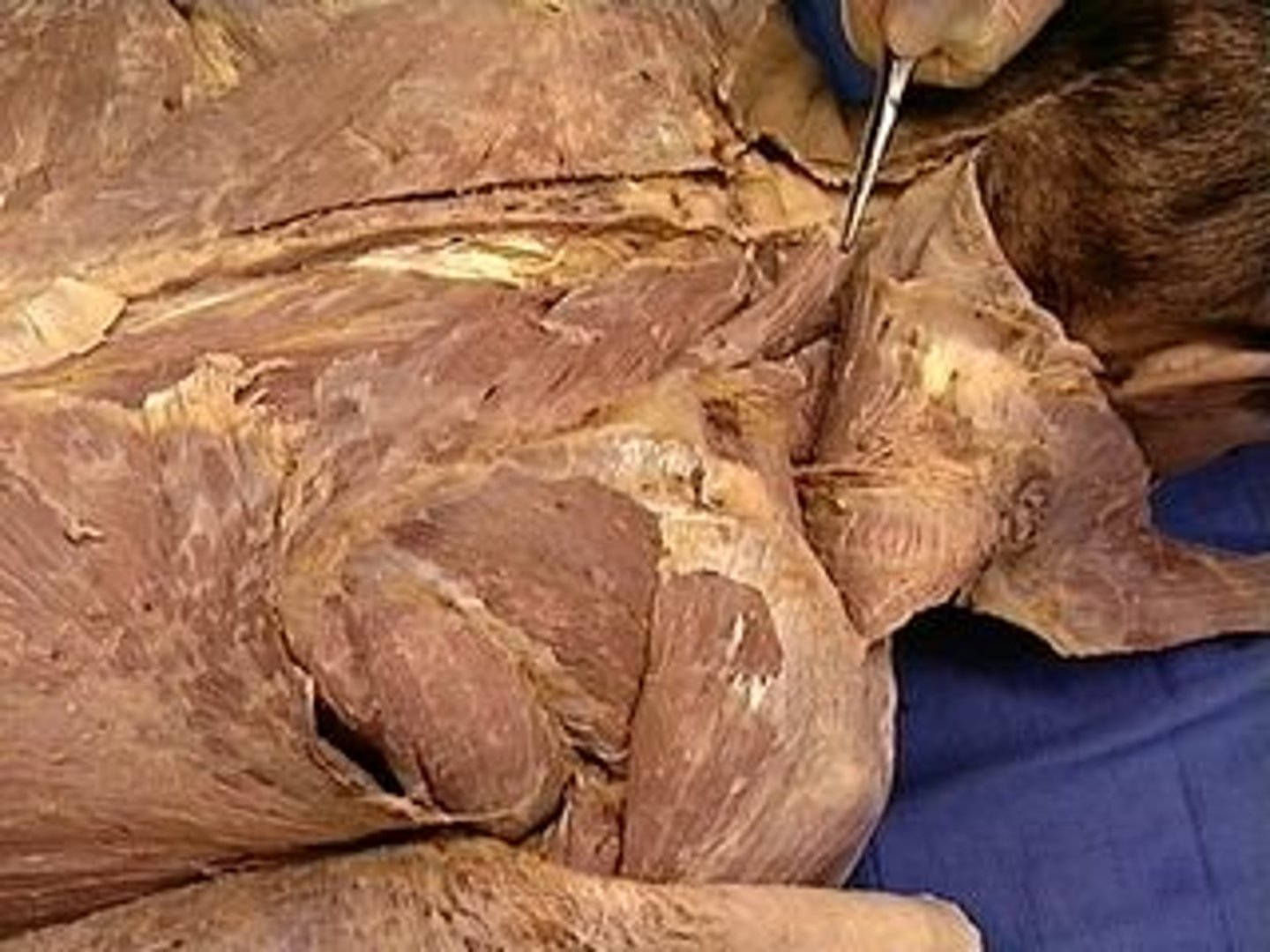 <p>Adduct the scapula (scapulothoracic joint), elevate the scapula, downwardly rotate the scapula; anterior surface of medial border of scapula</p>